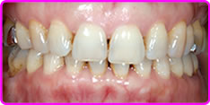 歯列矯正の抜歯による影響