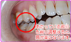歯列矯正の抜歯による影響