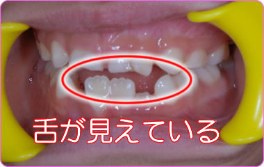 歯の隙間から舌が見えてしまっている写真